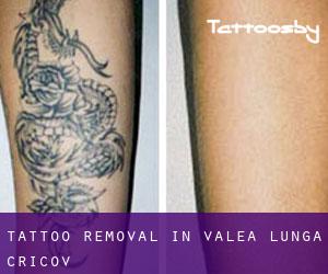 Tattoo Removal in Valea Lungă-Cricov
