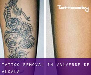 Tattoo Removal in Valverde de Alcalá