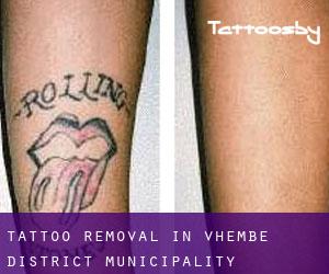 Tattoo Removal in Vhembe District Municipality