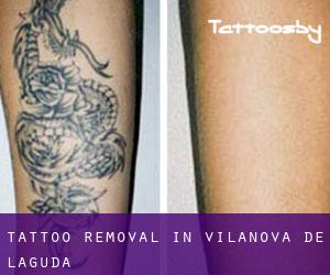 Tattoo Removal in Vilanova de l'Aguda
