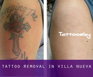 Tattoo Removal in Villa Nueva