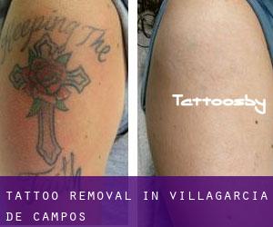 Tattoo Removal in Villagarcía de Campos