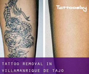 Tattoo Removal in Villamanrique de Tajo