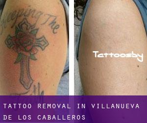 Tattoo Removal in Villanueva de los Caballeros