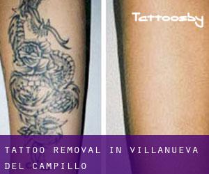 Tattoo Removal in Villanueva del Campillo