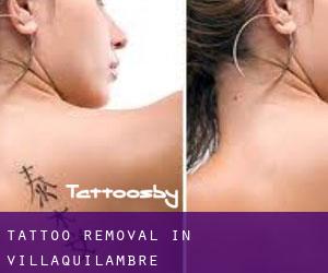 Tattoo Removal in Villaquilambre