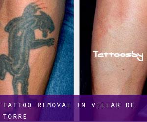 Tattoo Removal in Villar de Torre
