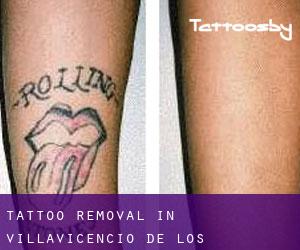 Tattoo Removal in Villavicencio de los Caballeros