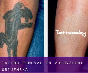 Tattoo Removal in Vukovarsko-Srijemska