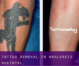 Tattoo Removal in Wahlkreis Rheintal