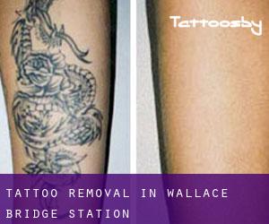 Tattoo Removal in Wallace Bridge Station