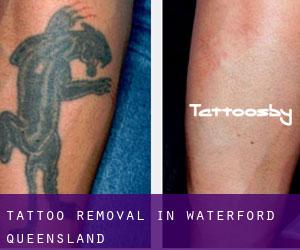 Tattoo Removal in Waterford (Queensland)