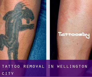Tattoo Removal in Wellington (City)