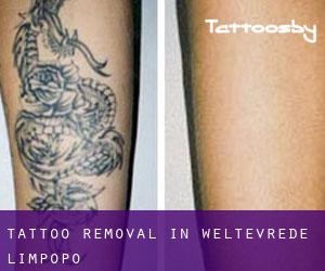 Tattoo Removal in Weltevrede (Limpopo)