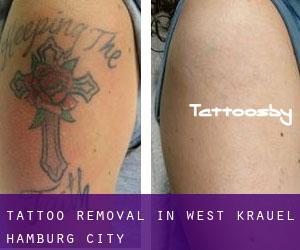 Tattoo Removal in West Krauel (Hamburg City)