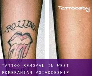 Tattoo Removal in West Pomeranian Voivodeship