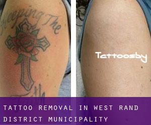 Tattoo Removal in West Rand District Municipality