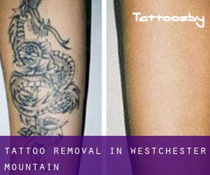 Tattoo Removal in Westchester Mountain