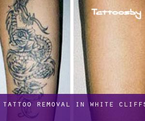 Tattoo Removal in White Cliffs