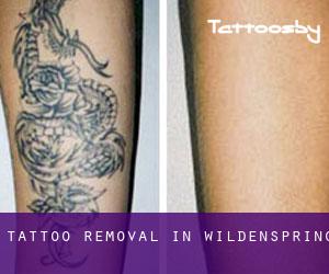Tattoo Removal in Wildenspring