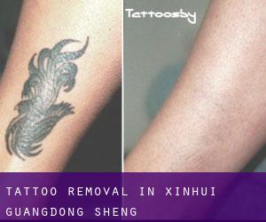 Tattoo Removal in Xinhui (Guangdong Sheng)