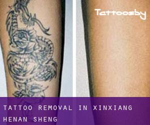 Tattoo Removal in Xinxiang (Henan Sheng)
