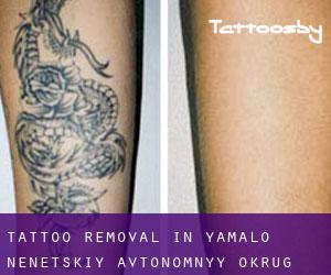Tattoo Removal in Yamalo-Nenetskiy Avtonomnyy Okrug