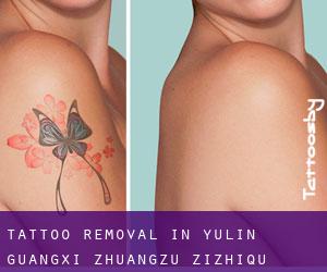 Tattoo Removal in Yulin (Guangxi Zhuangzu Zizhiqu)