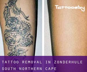 Tattoo Removal in Zonderhule South (Northern Cape)
